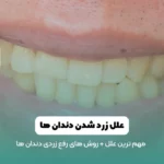 زرد شدن دندان ها