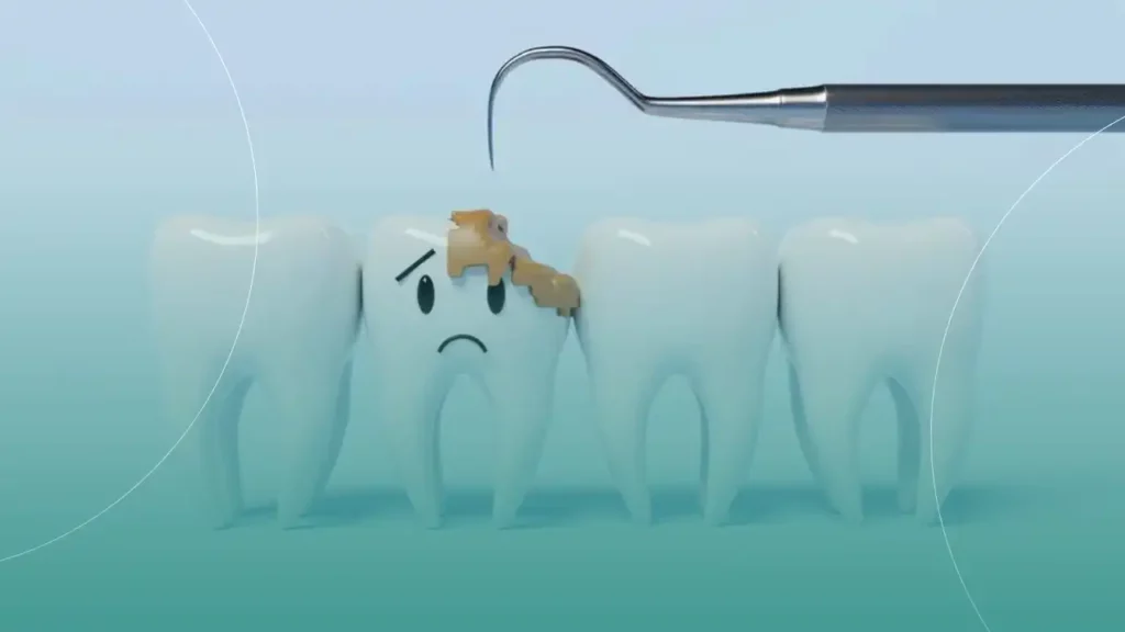 آسیب به مینای دندان