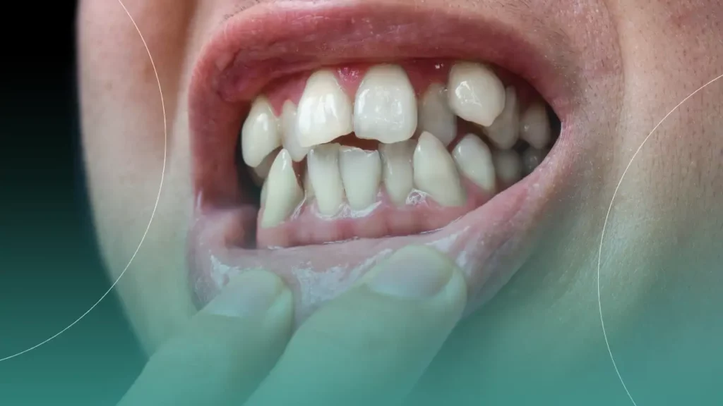 هزینه ارتودنسی دندان های شلوغ