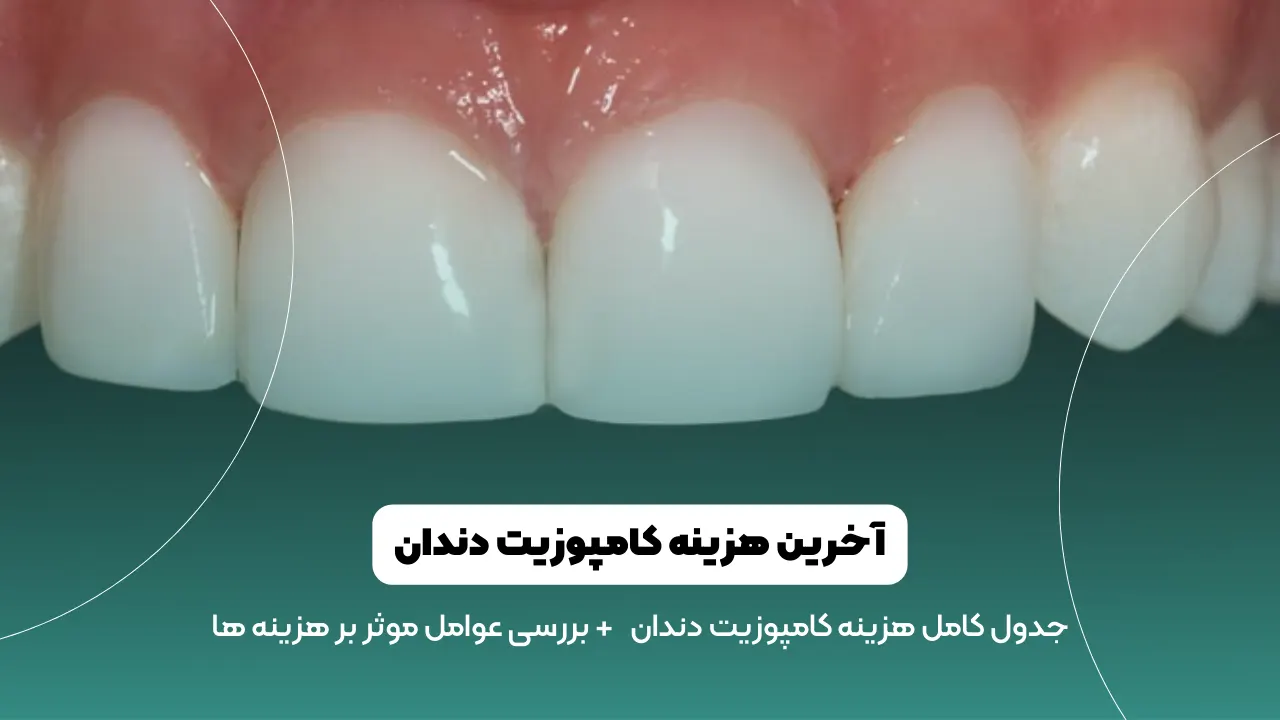 هزینه کامپوزیت دندان