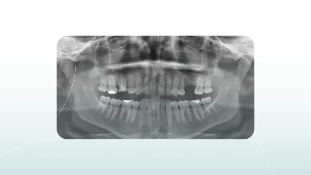 یک عکس دندان که دندانپزشکان با کمک آن می توانند بهترین تشخیص را ارایه دهند
