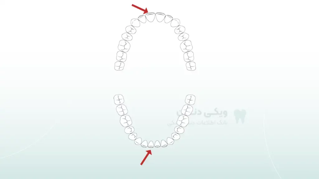 عکس دومین دندان دائمی (ثنایا مرکزی)
