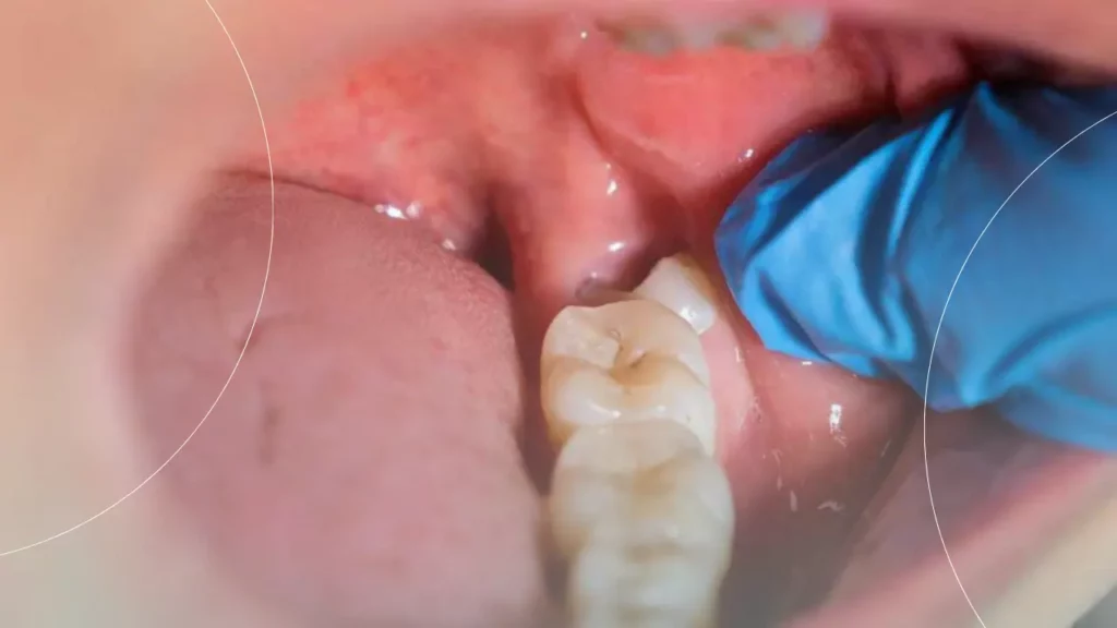 کشیدن دندان با جراحی
