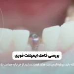 ایمپلنت فوری دندان شاخص