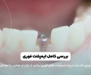 ایمپلنت فوری دندان شاخص