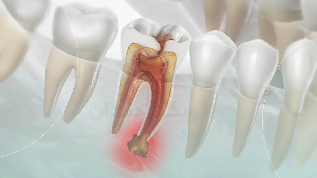 عکس عفونت دندان (شماتیک)