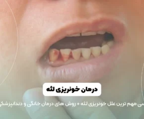 خونریزی لثه شاخص