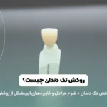 روکش تک دندان عکس