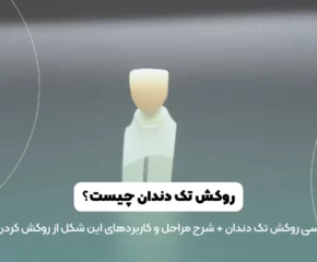 روکش تک دندان عکس