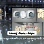 تصویر شاخص ایمپلنت دیجیتال