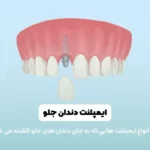 ایمپلنت دندان جلو شاخص