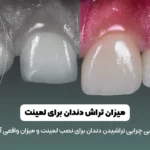 میزان تراش دندان برای لمینت شاخص