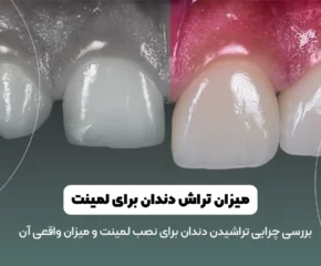 میزان تراش دندان برای لمینت شاخص