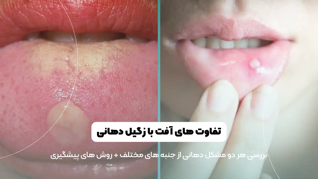 زگیل دهانی از چه طریقی منتقل میشود؟