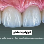 انواع لمینت دندان