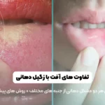 تفاوت آفت با زگیل دهان شاخص
