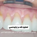 تحلیل لثه در ارتودنسی شاخص