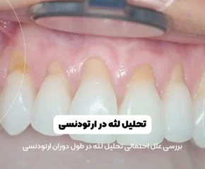 تحلیل لثه در ارتودنسی شاخص