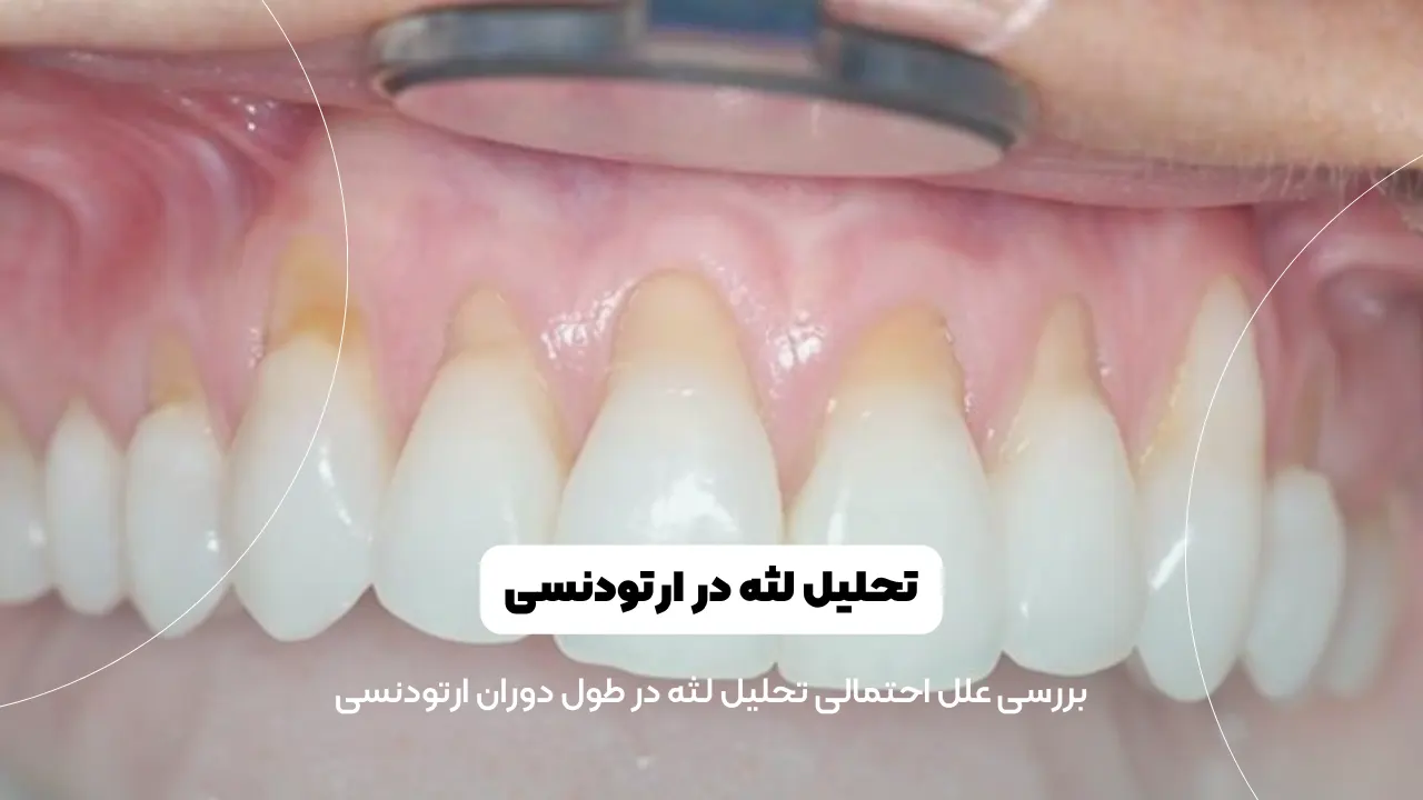 تحلیل لثه در ارتودنسی شاخص