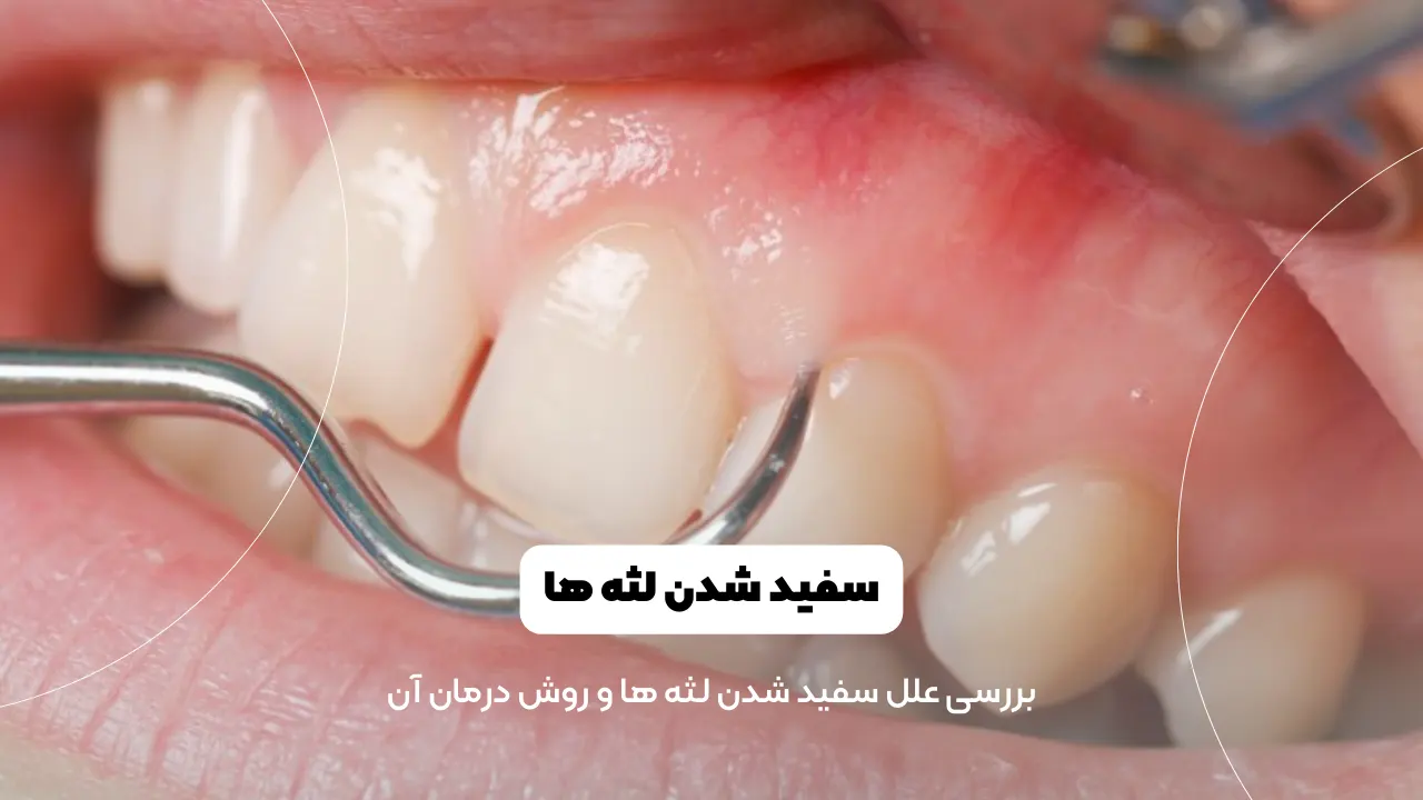 سفید شدن لثه ها شاخص
