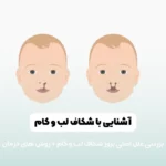 شکاف لب و کام شاخص