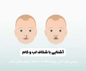 شکاف لب و کام شاخص