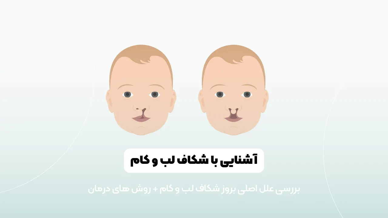 شکاف لب و کام شاخص