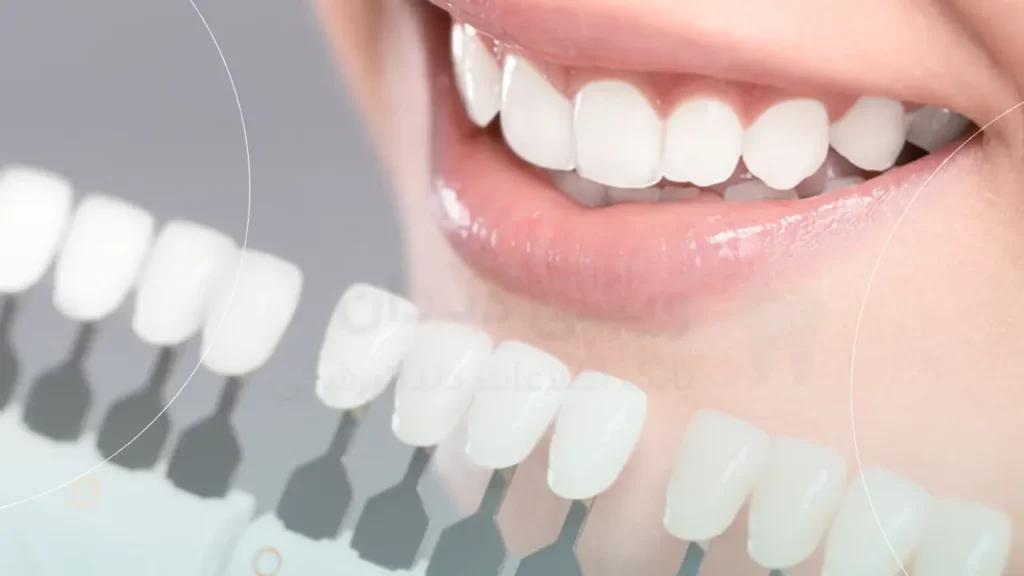 اصلاح لمینت بعد از پایان ارتودنسی