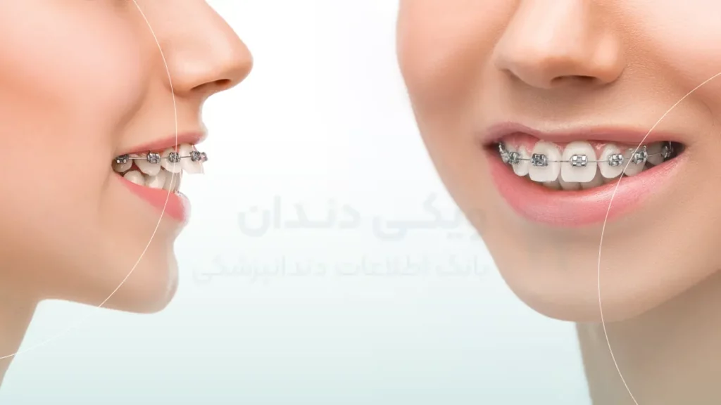 انواع ناهنجاری قبل از ارتودنسی