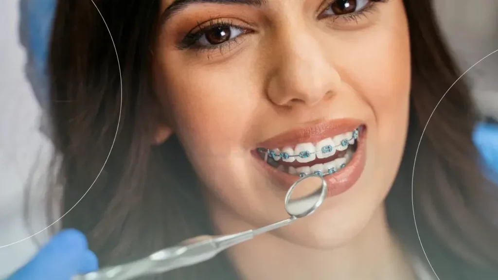 براکت ارتودنسی در یک دختر جوان