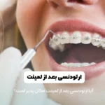 ارتودنسی بعد از لمینت