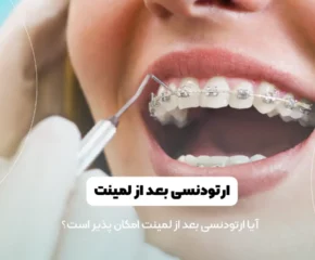 ارتودنسی بعد از لمینت