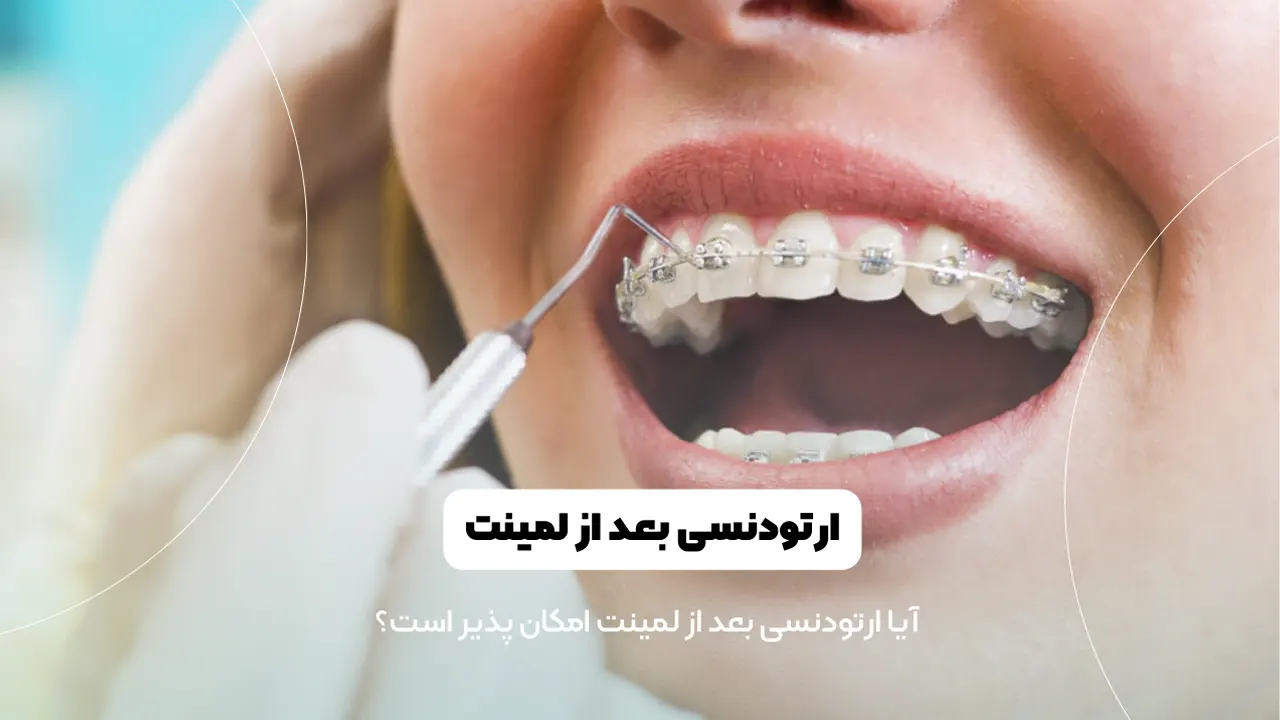 ارتودنسی بعد از لمینت