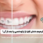 ترمیم دندان قبل یا بعد از ارتودنسی