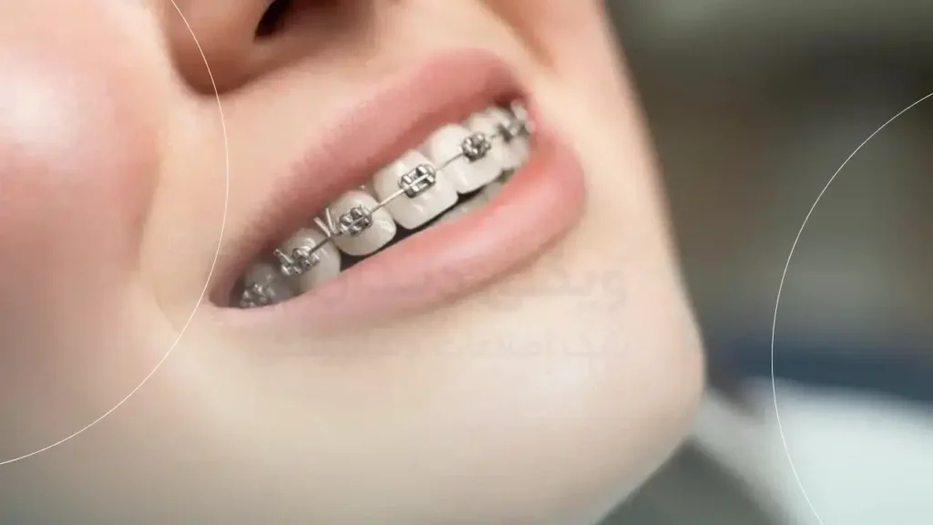 شرایط ارتودنسی تک فک شاخص