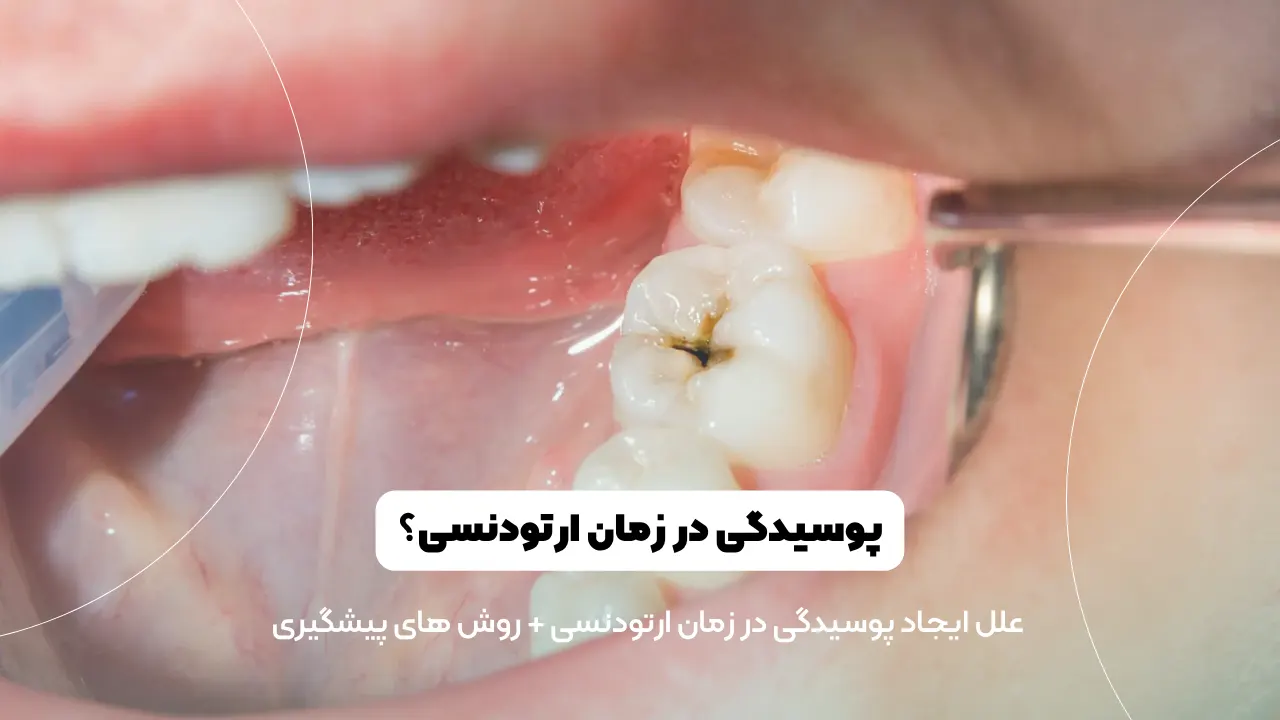 پوسیدگی دندان در زمان ارتودنسی