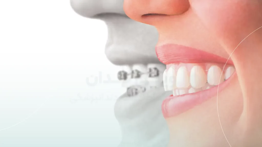 ایجاد بایت پایدار با ارتودنسی
