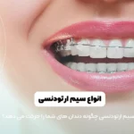 انواع سیم ارتودنسی