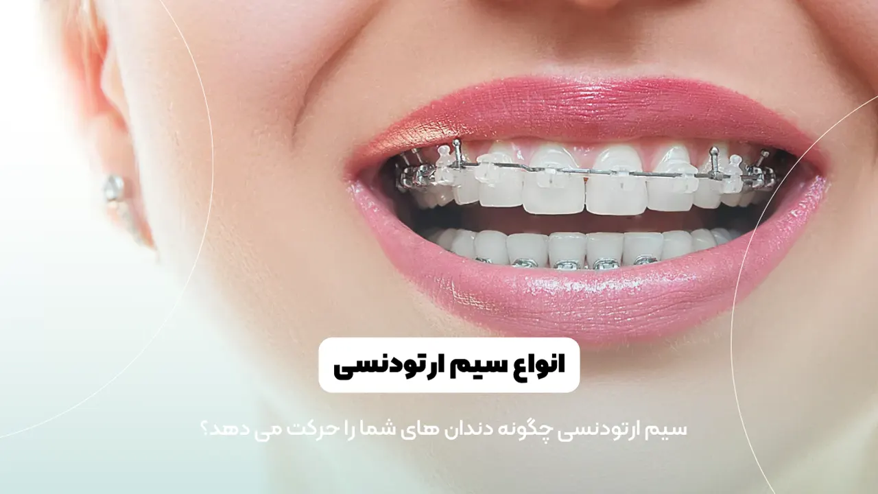 انواع سیم ارتودنسی