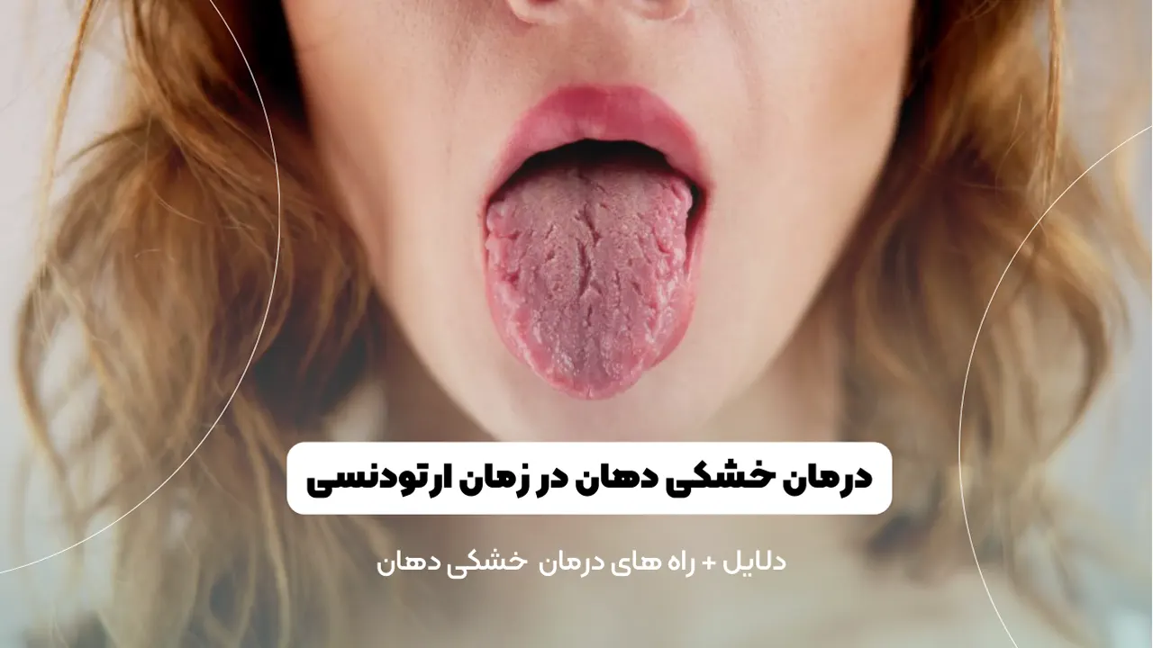 درمان خشکی دهان در زمان ارتودنسی