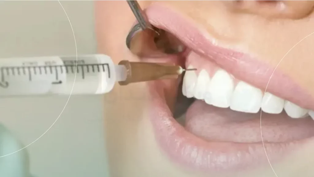 تزریق Dental infiltration