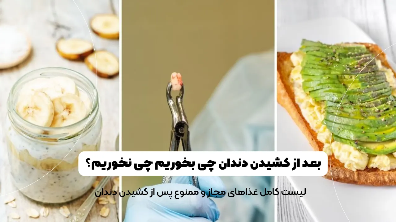 بعد از کشیدن دندان چی بخوریم چی نخوریم؟