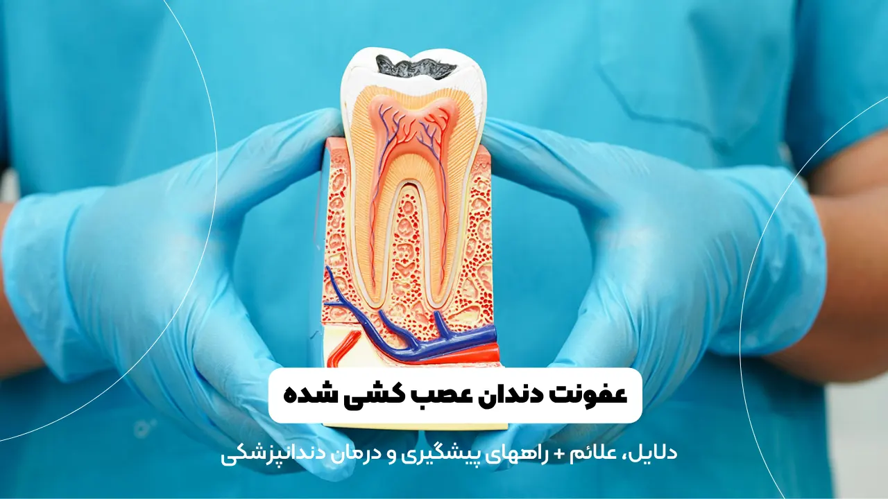 عفونت دندان عصب کشی شده