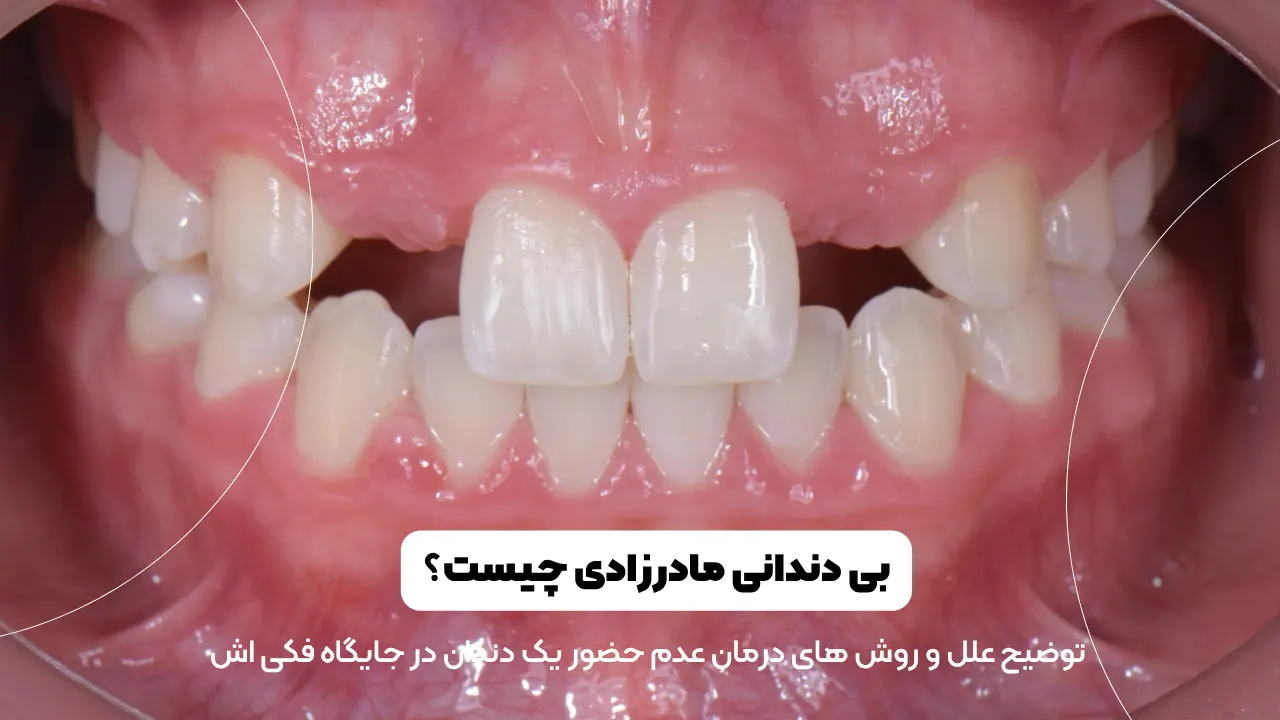 بی دندانی مادرزادی