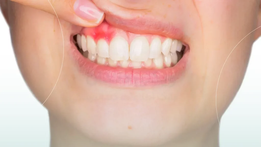 التهاب لثه در افراد دیابتی