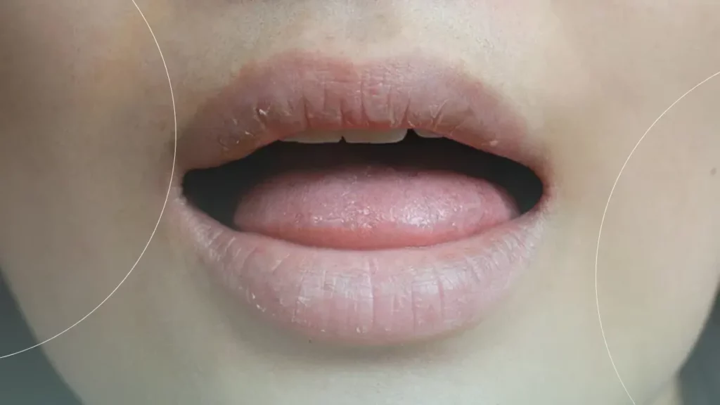 خشکی دهان بیماران دیابتی