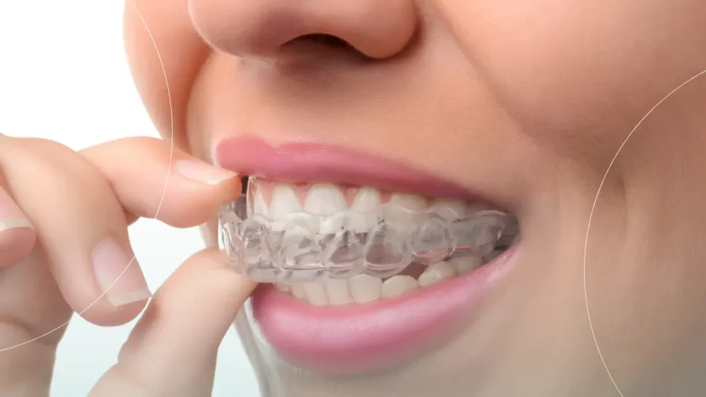 راحتی و زیبایی ارتودنسی نامرئی