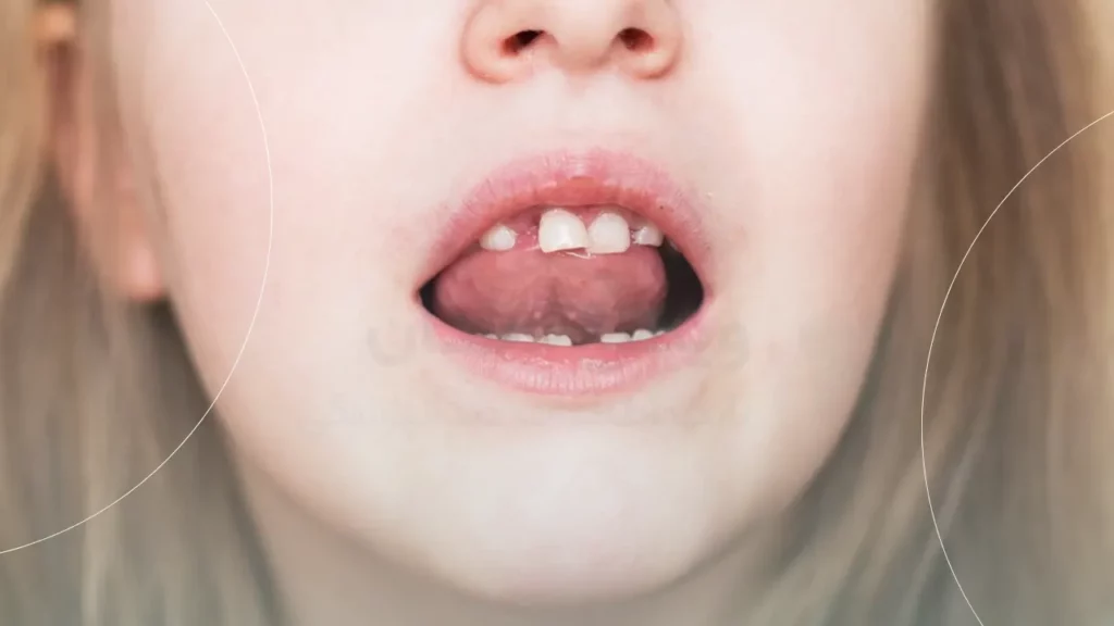فشار دادن زبان به دندان در کودکان