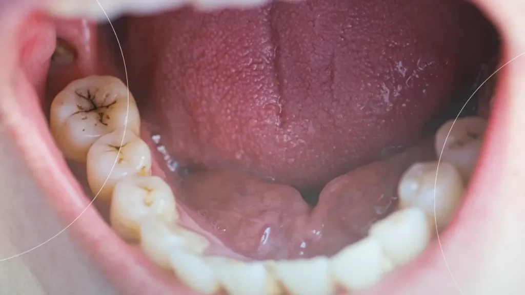 پوسیدگی دندان در بیماران دیابتی