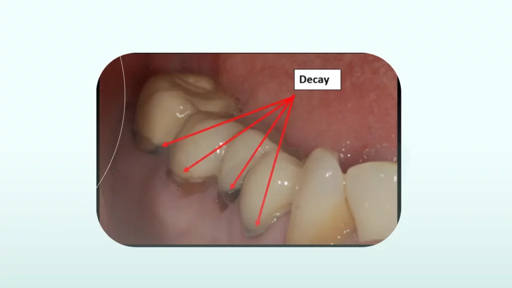 وسیدگی زیر روکش دندان